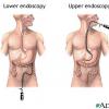 Endoscopy